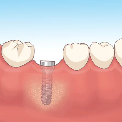 治癒期間（インプラントと骨がくっつく期間）