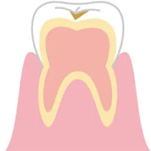 C0 （シーオー）エナメル質が溶解し始める