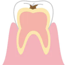 C1 エナメル質に穴が開く