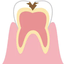 C2 虫歯が象牙質にまで到達