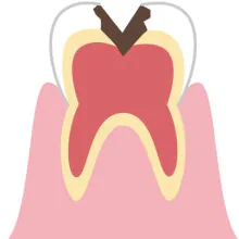 C3 虫歯が神経にまで到達