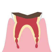 C4 歯冠部が失われ、歯の根だけが残る状態