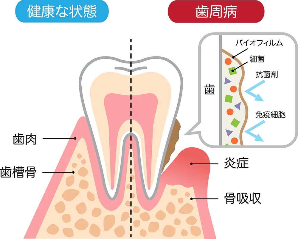 歯周病はどんな病気？