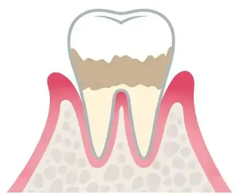 軽度歯周病