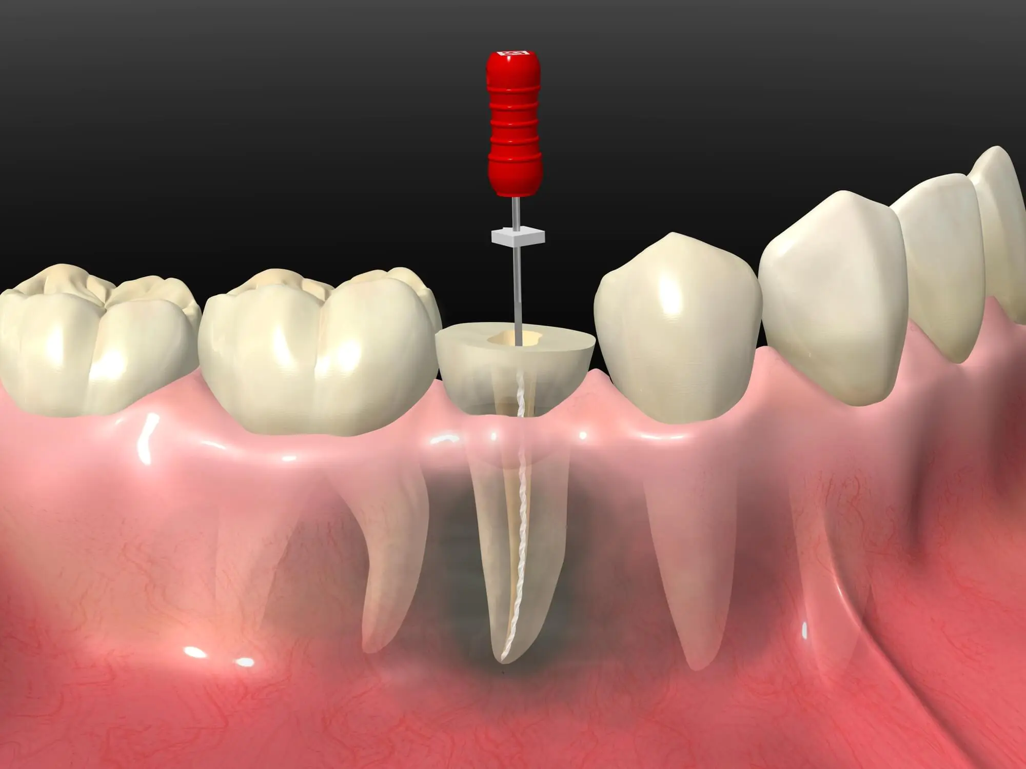 歯を残すための最後の治療である「根管治療」