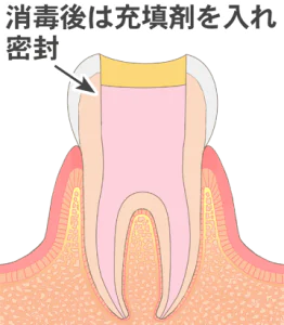 薬剤を充填